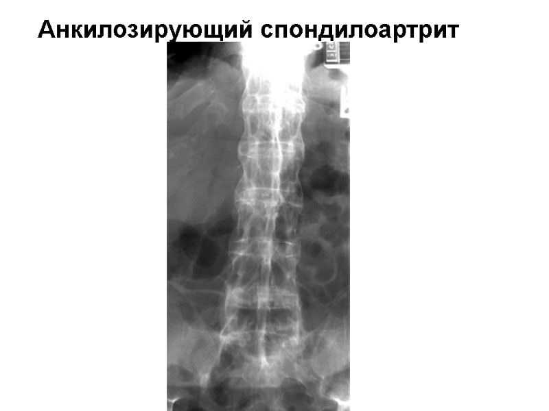 Анкилозирующий спондилоартрит